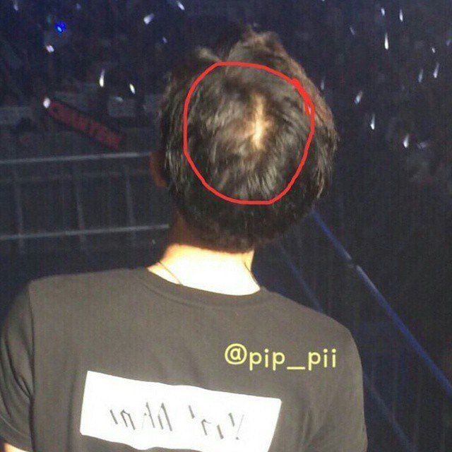 Chanyeol's "bald spot"