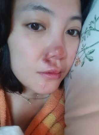 Go Eun Ah dengan Memar
